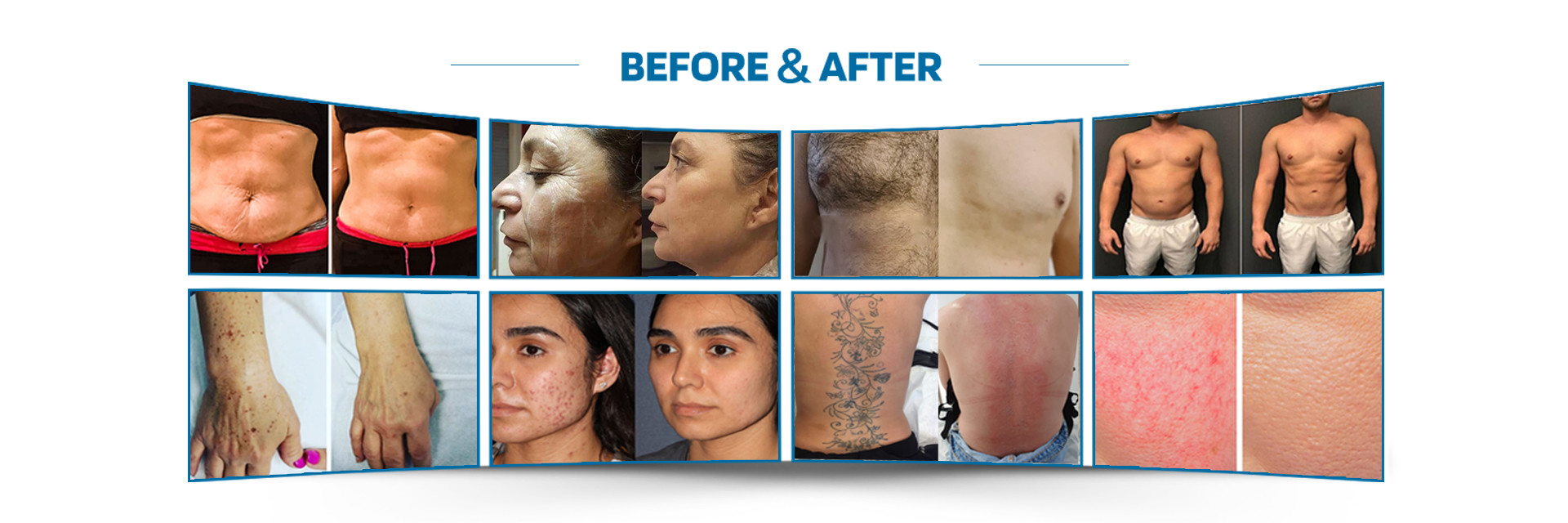 คุณภาพ เครื่องเลเซอร์กำจัดขน โรงงาน